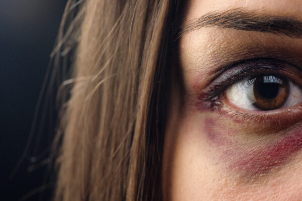 Woman With A Black Eye Crying