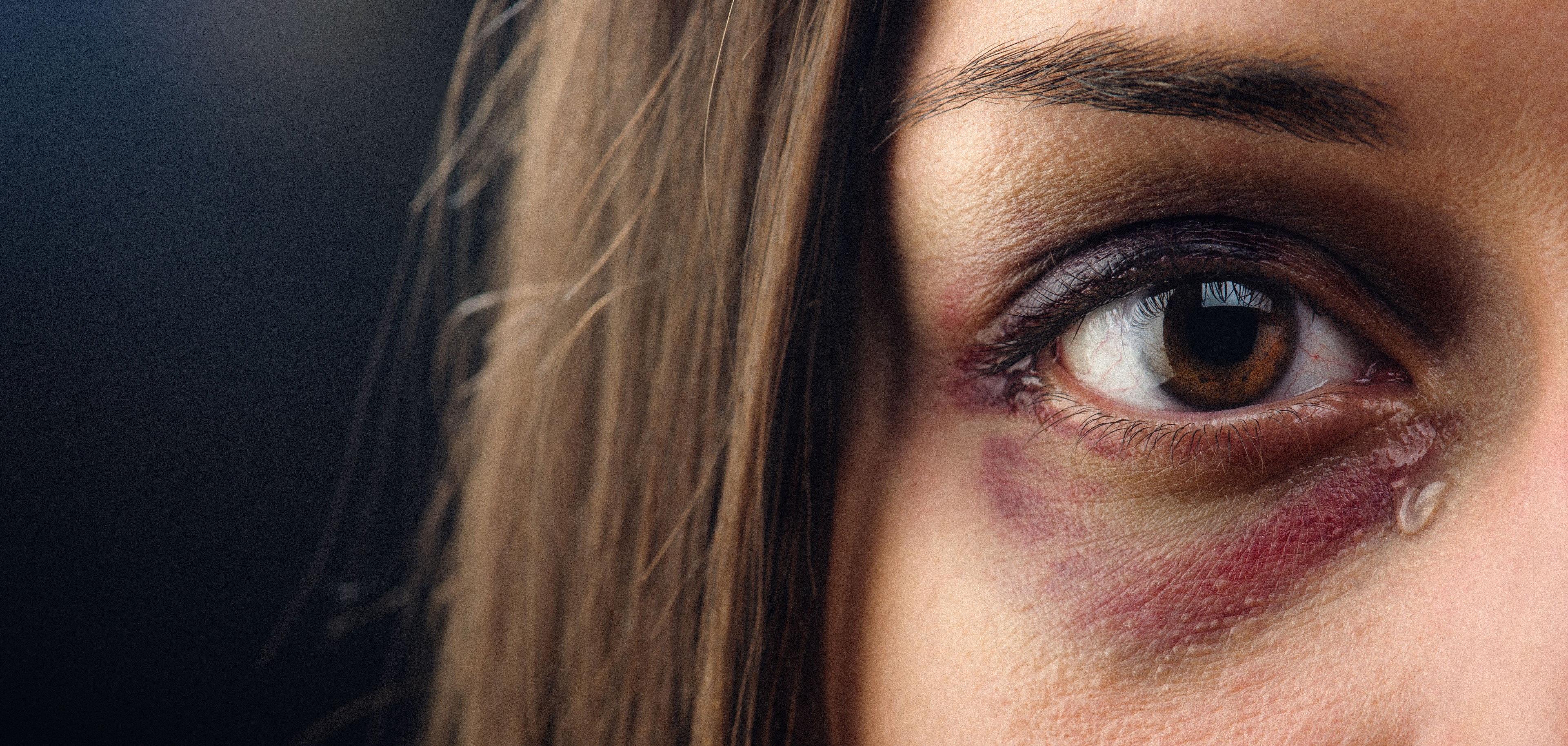 woman with a black eye crying