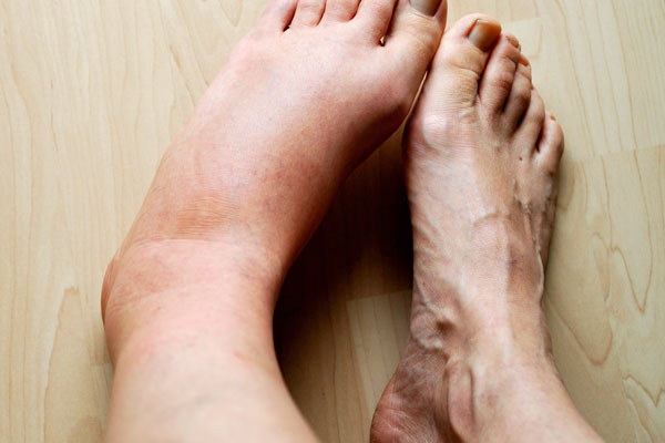 unhealthy heart signs - swollen legs and feet