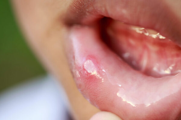 Canker Sores Treatment