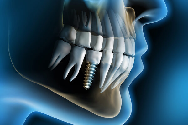 Dental Implants