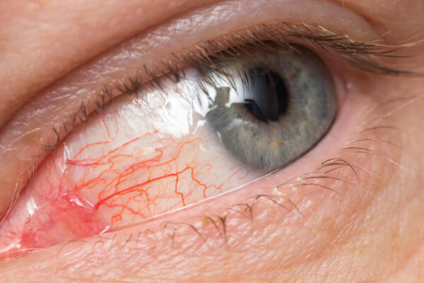 Eye Redness Is A Common Symptom Of Pink Eye