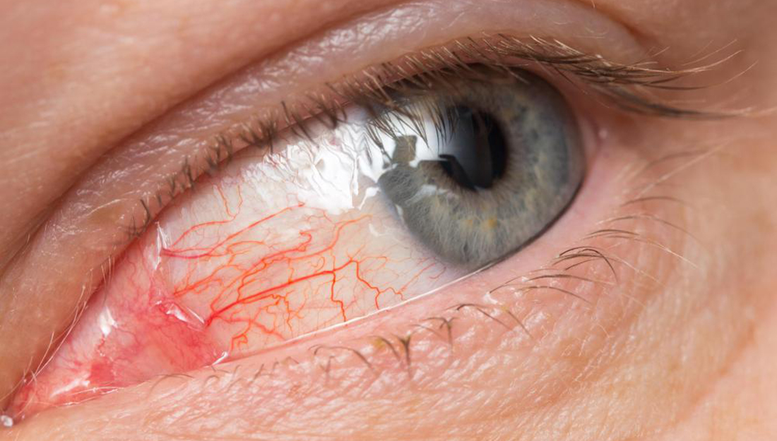 Eye redness is a common symptom of pink eye