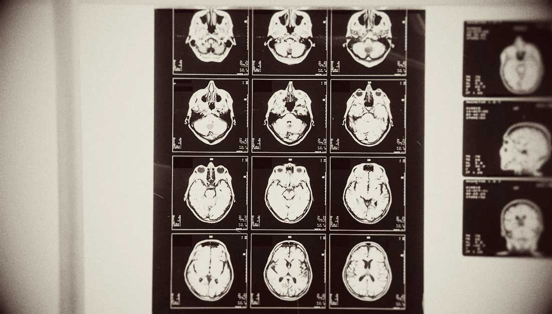 Concussions can have lasting physical and mental health issues if not managed properly