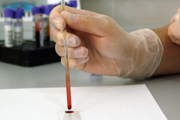 Blood Test May Help Identify Fetal Alcohol Disorders