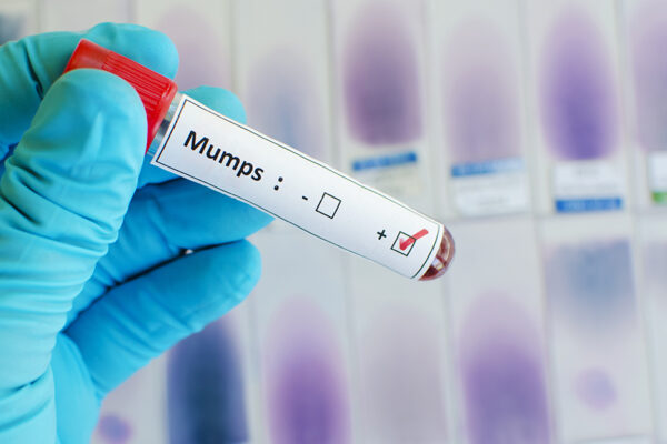 Mumps