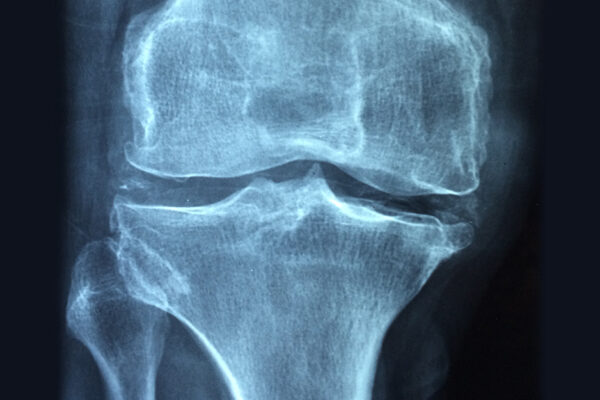 Osteoarthritis Is A Common Condition, But The Best Management Is An Active Lifestyle