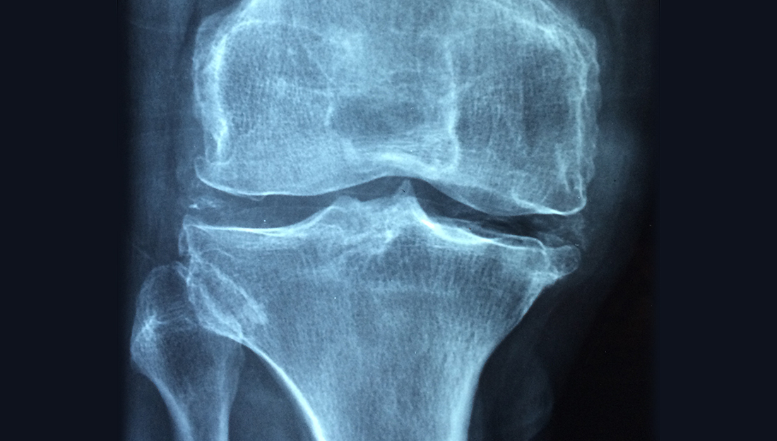 Osteoarthritis is a common condition, but the best management is an active lifestyle