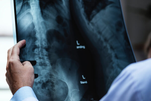 Lower Back Pain_A Physician Is Looking At An X-ray Of A Spine