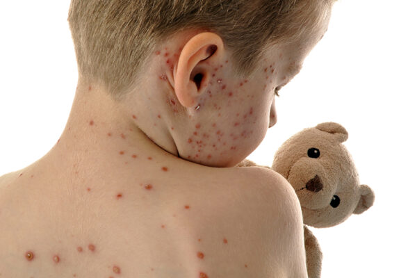 Child With Measles Holds A Teddy Bear - Measles Vaccination