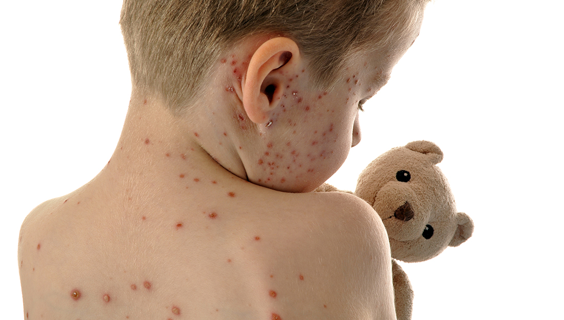 Child with measles holds a teddy bear - measles vaccination