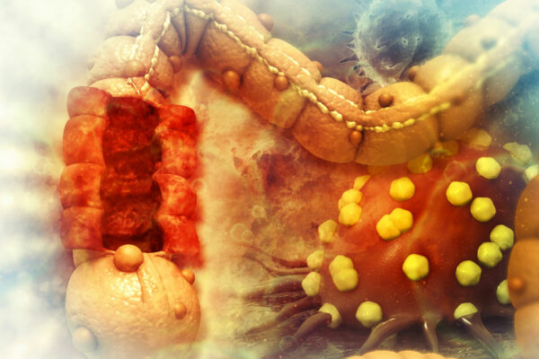 3D Illustration Of Colon Cancer Closeup