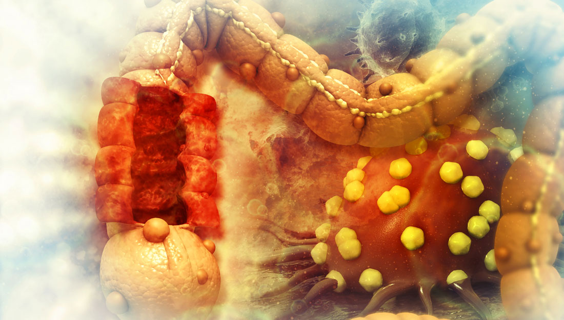 3D illustration of colon cancer closeup