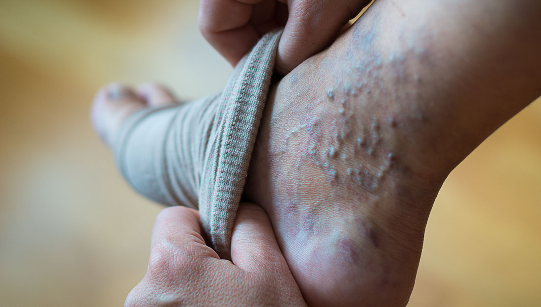 a woman puts a compression stocking on her leg with varicose veins