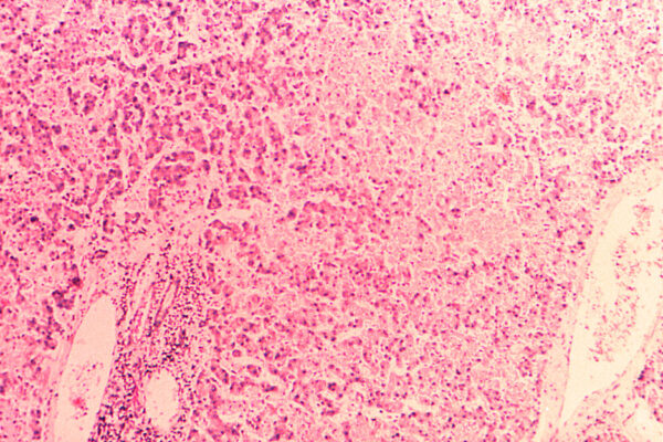 Under A Magnification Of 100X, This Hematoxylin-eosin-stained (H&E) Photomicrograph Depicts The Cytoarchitectural Changes Found In A Liver Tissue Specimen Extracted From A Lassa Fever Patient.