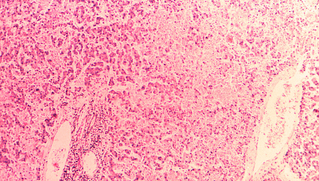 Under a magnification of 100X, this hematoxylin-eosin-stained (H&E) photomicrograph depicts the cytoarchitectural changes found in a liver tissue specimen extracted from a Lassa fever patient.